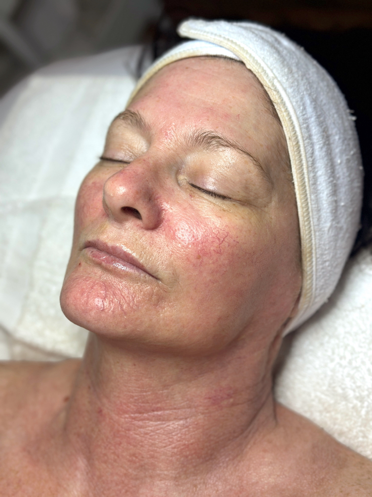 Skin Consultation (FaceTime/Text)
