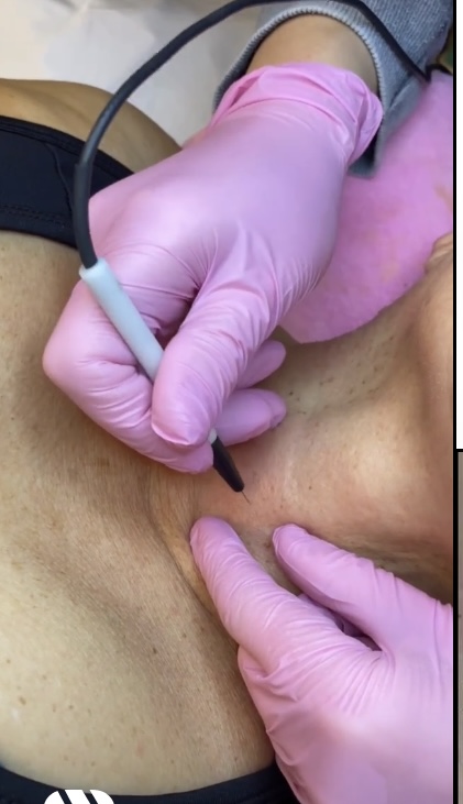 Skin Classic (Skin Tag Removal)