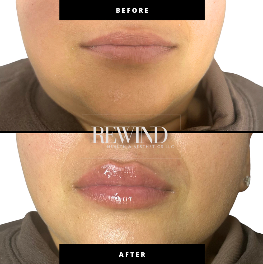 Full Lip Plump at Rewind Health & Aesthetics LLC in San Marcos, TX