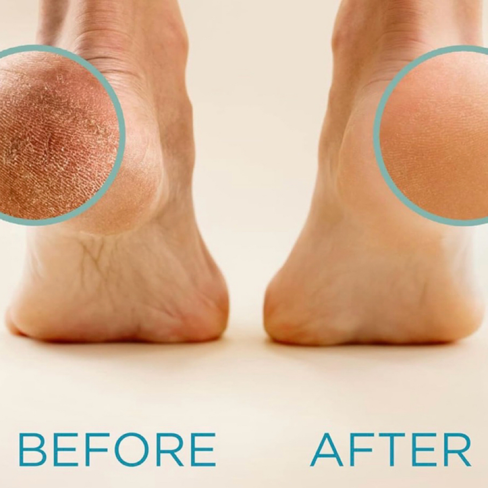 Callus Treatment at MK Nails in Cullman, AL