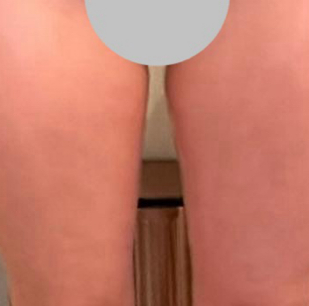 Inner thigh at Silhouette Body Sculpting LLC in St. Peter’s, MO