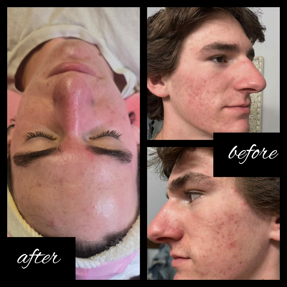 Acne Facial