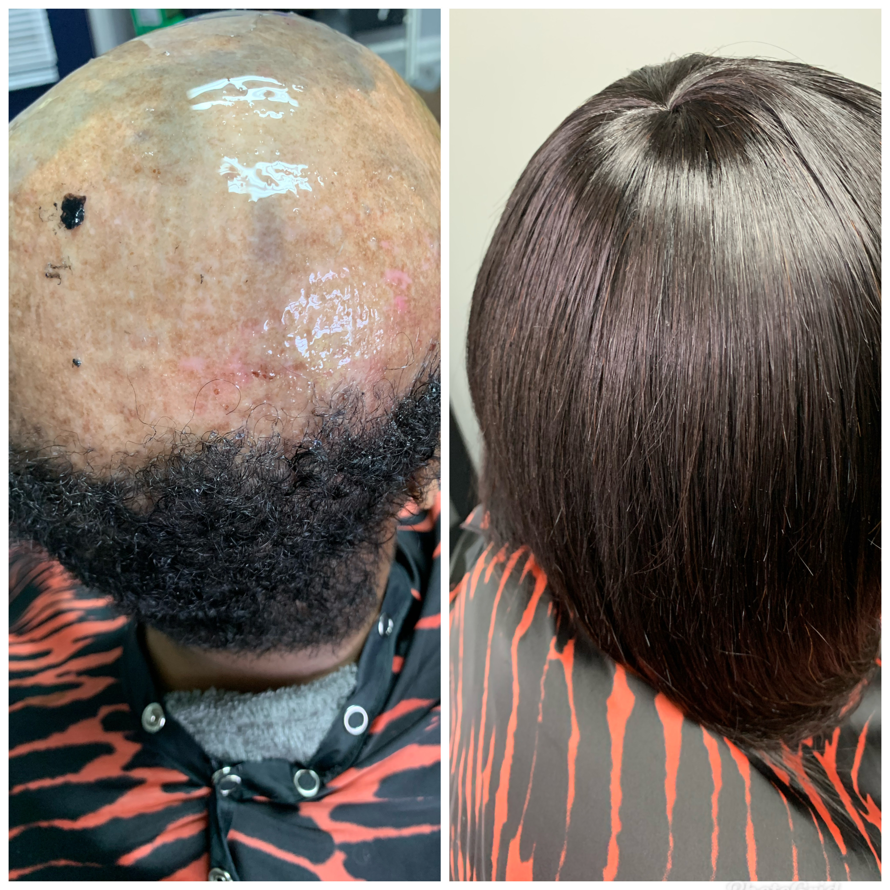Alopecia Areata Consult(hair Loss)