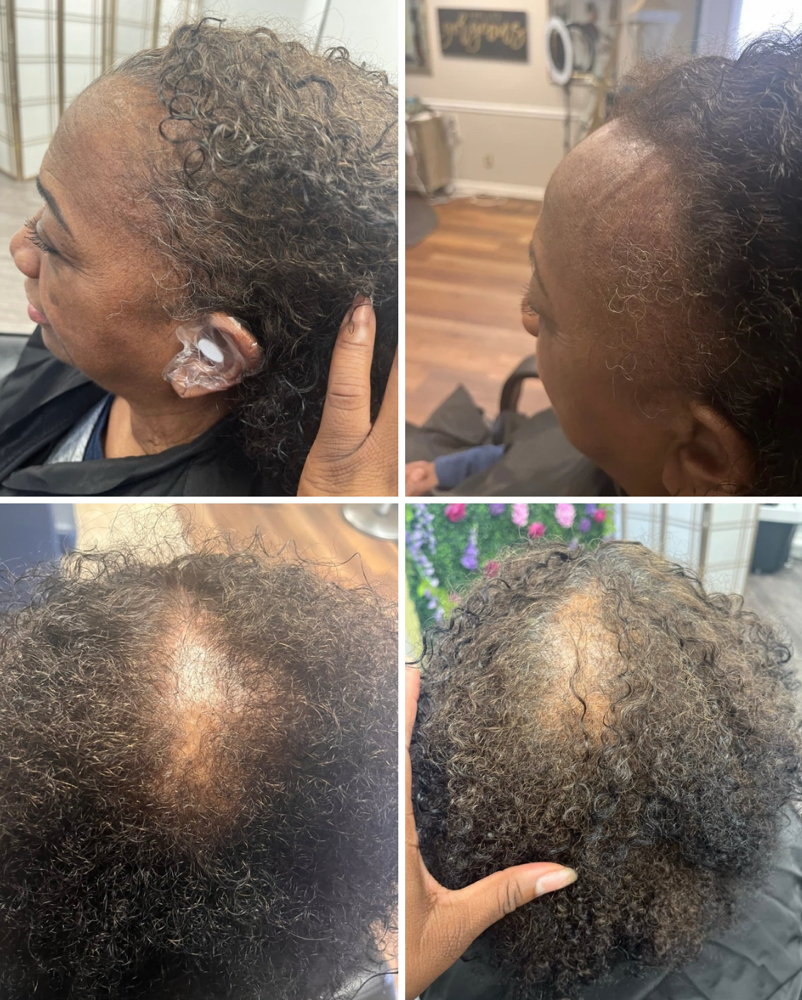 RiiGrowth Trial Treatment