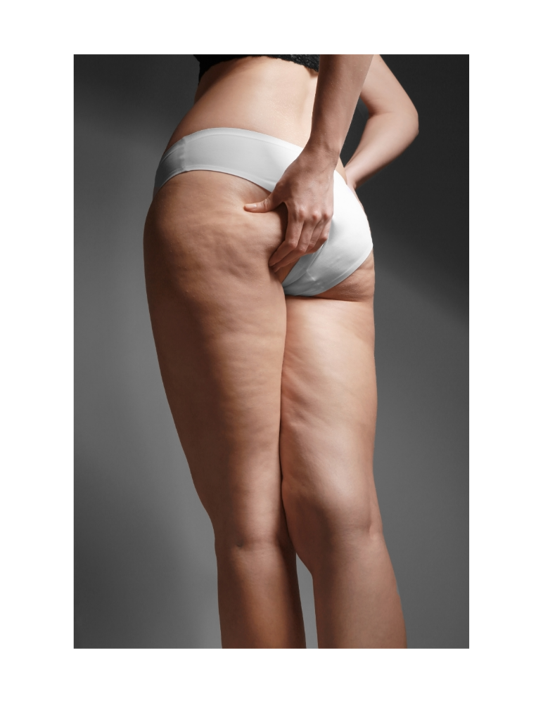 Cellulite Treatment