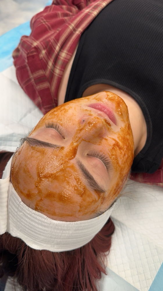 Chemical Exfoliation (peels)
