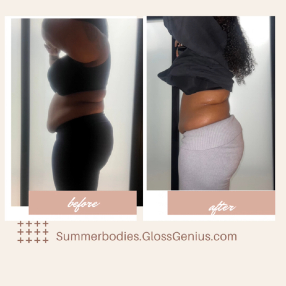 Bodysculpting Session at SummerBodies in Torrance, CA