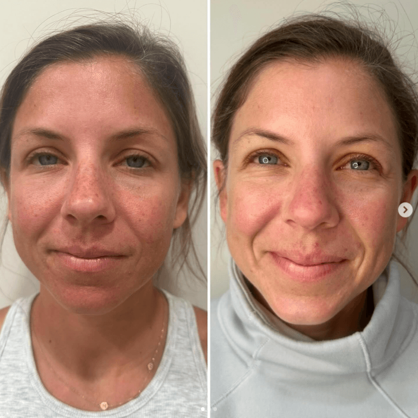 EXOSOME BRIGHTENING W/ MICRONEEDLE