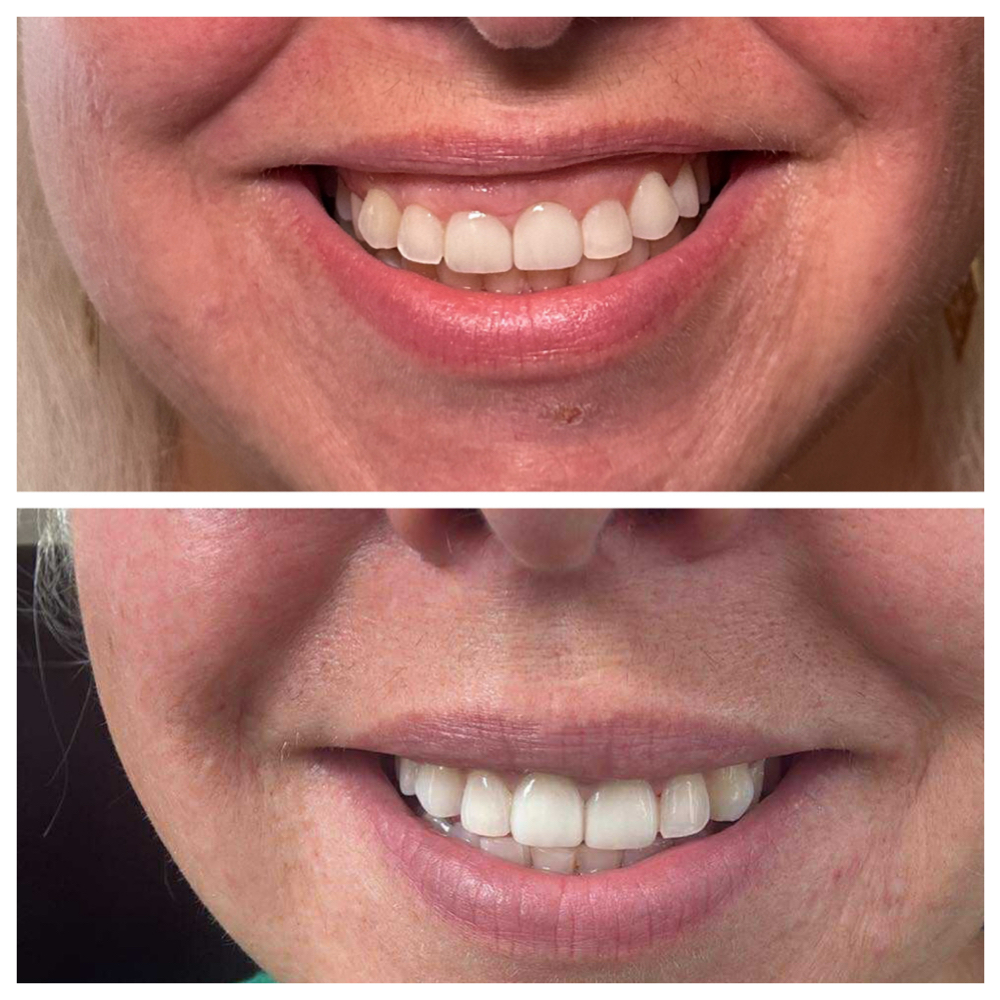 Gummy Smile With Lip Flip at SCL Aesthetics in Putnam, CT