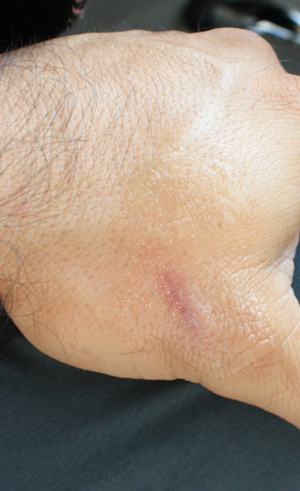 Scar Reduction