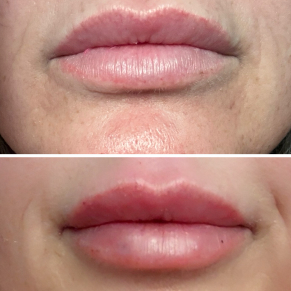 Juvederm Lip Filler at Groomsology MedSpa in Mt Orab, OH