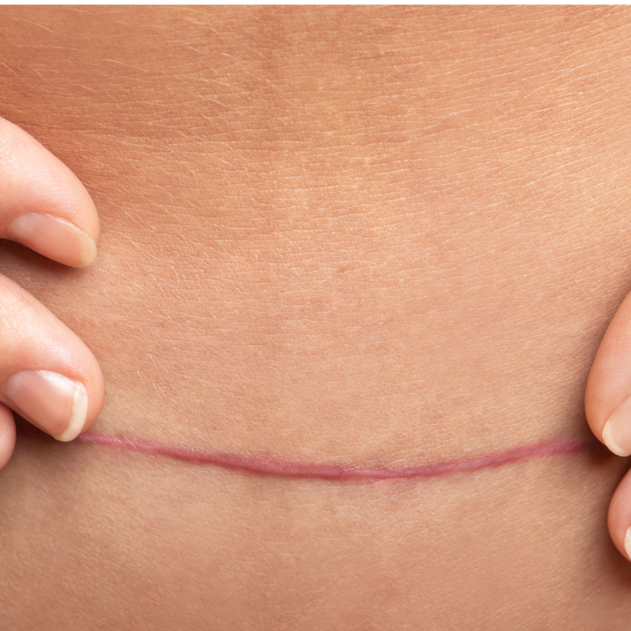 Scar Tissue Treatment at Fairhope Massage & Bodywork, LLC - Establishment E-3811 in Fairhope, AL