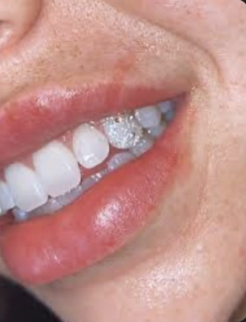 Chandalier Tooth at Lasting Impressions LHC in Lake Havasu City, AZ