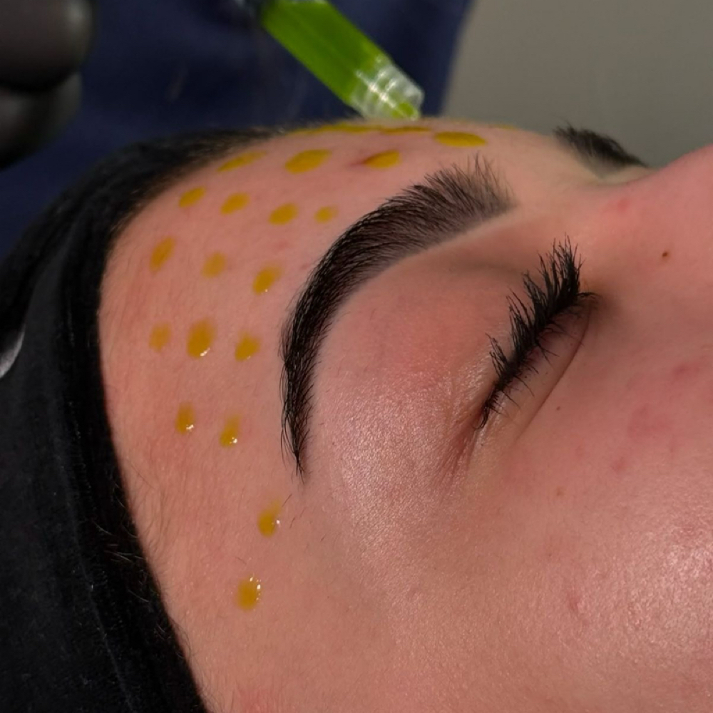 Biphasic Peel at Esthetics by Emily in Centerville, OH