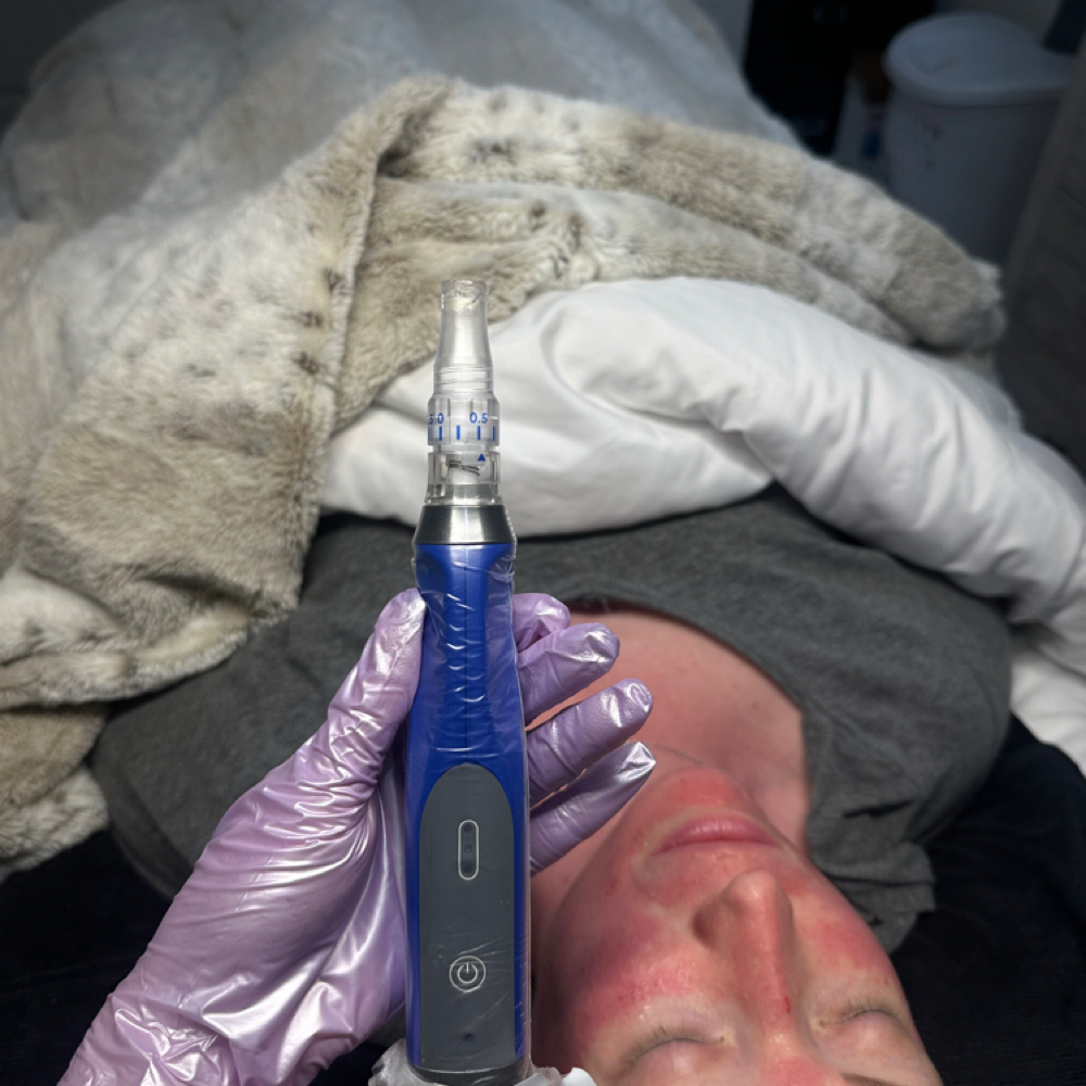 Microneedling neck & chest at Beautyy by Madison in madisonville, KY