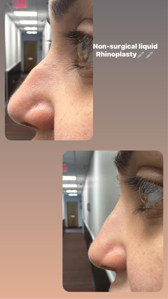 Non-surgical Nose Lift
