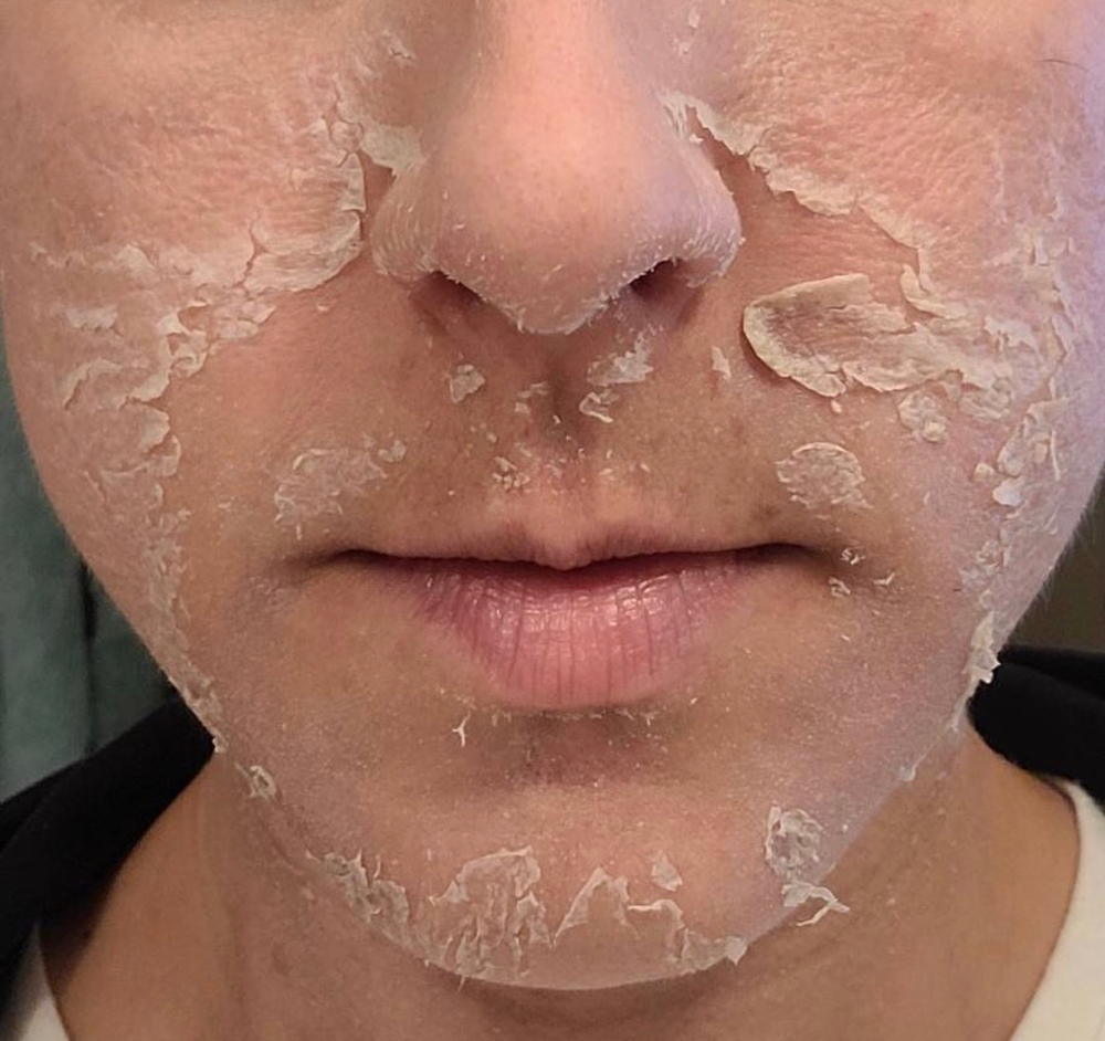Chemical Peels