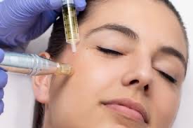 PRP Microneedling with Injections at Alabaster Beauty Co in Scottsdale, AZ