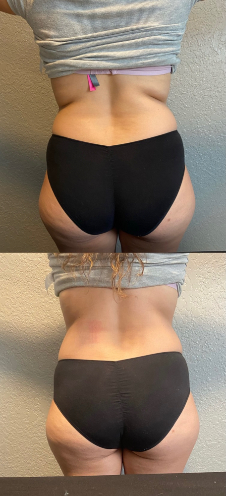 Body Contouring Package (3 Areas)