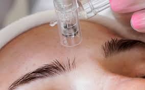 Microneedling face Neck Chest +Peel
