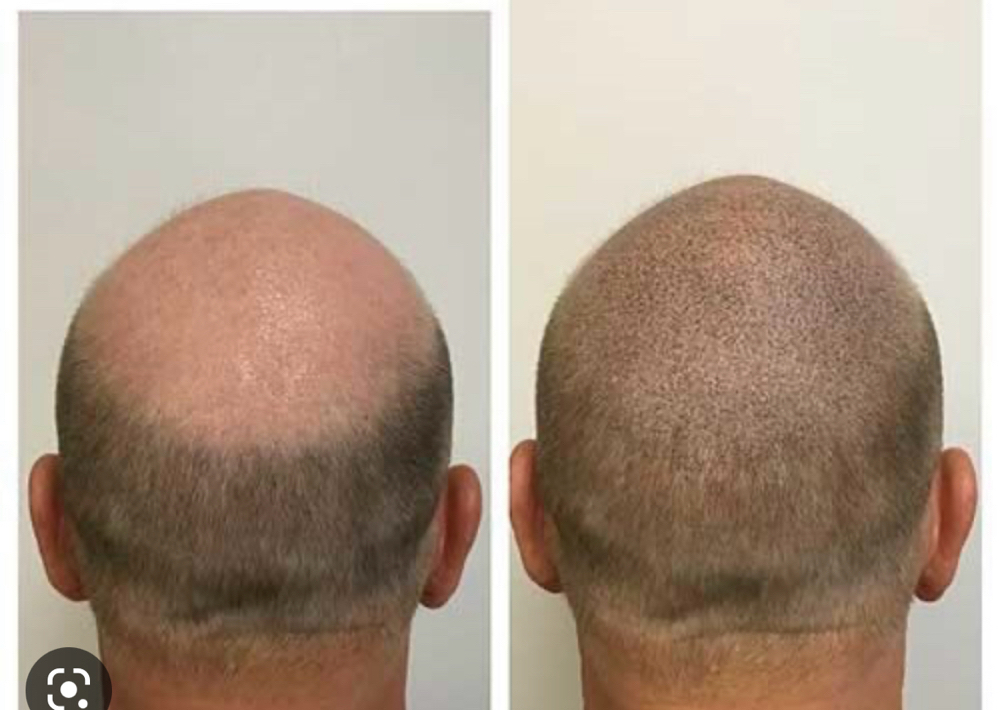 Scalp Micropigmentation(SMP)