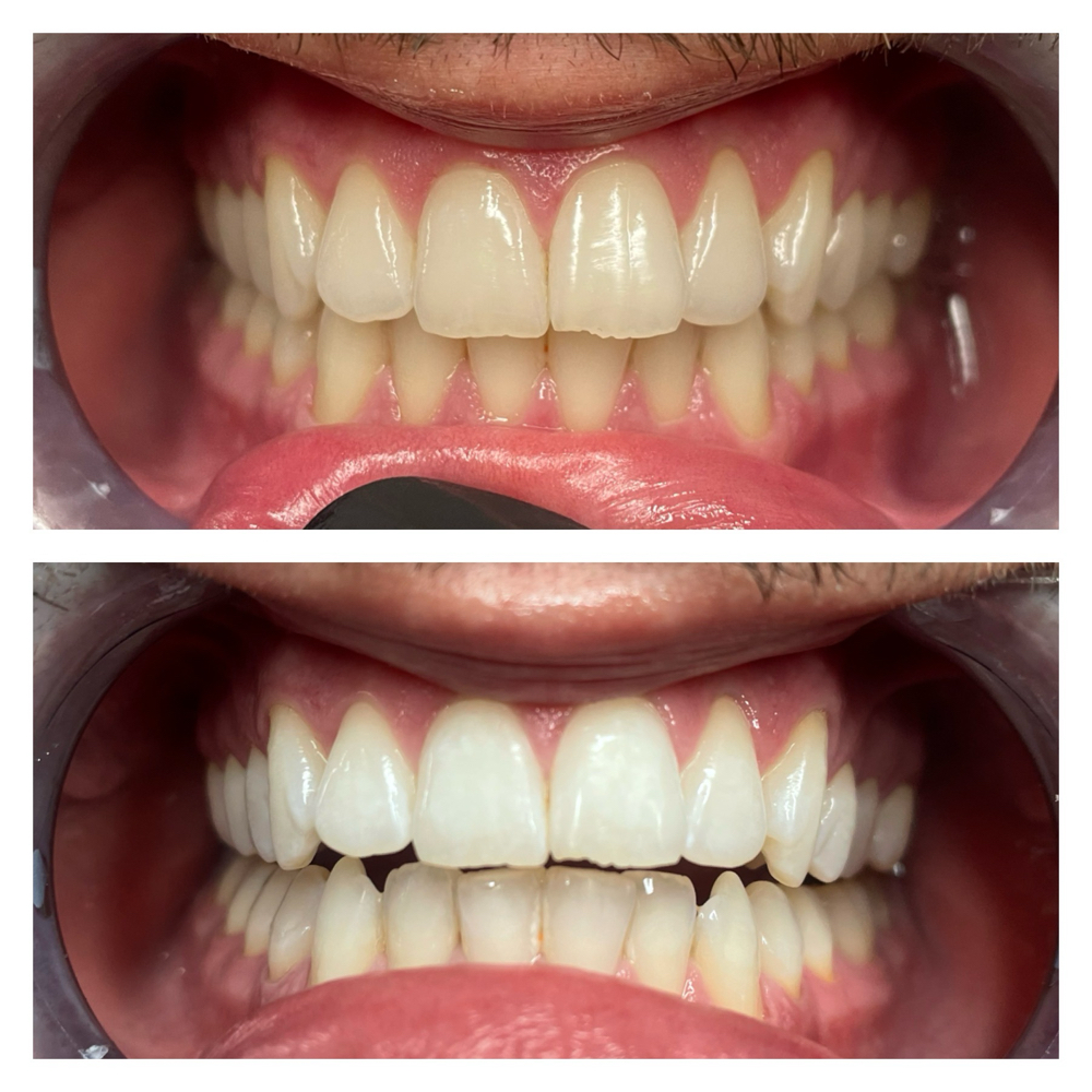 Teeth Whitening Treatment at Zoey Spa LLC in Chandler, AZ