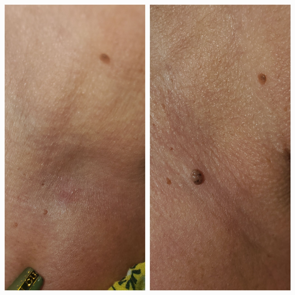 Mole Or Skin Tag Removal
