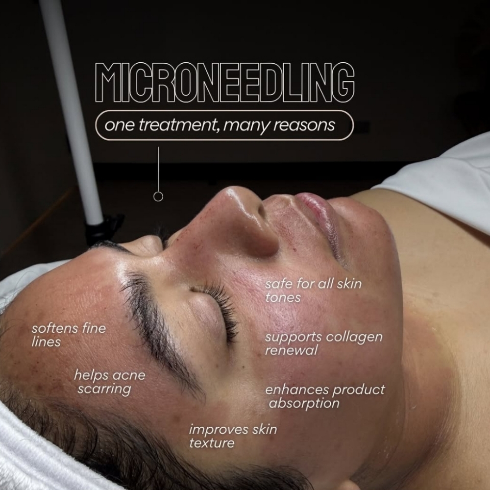 Microneedling Facial at EVERWELL LUXE in Kissimmee, FL