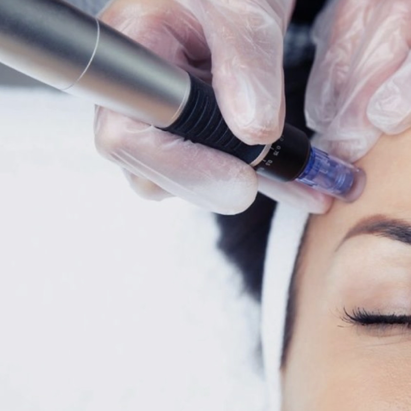 Microneedling