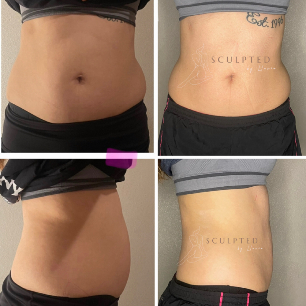 Cavi & Rf 360° 3 Session Special at Sculpted by Lluvia in Weslaco, TX