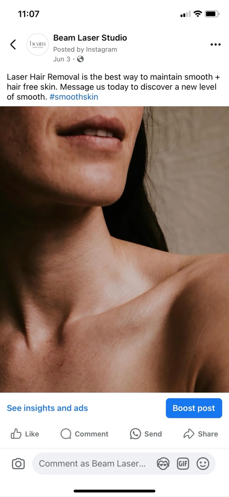 LASER HAIR REMOVAL CHIN