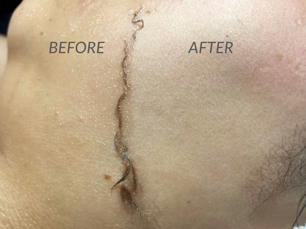 Dermaplane Facial