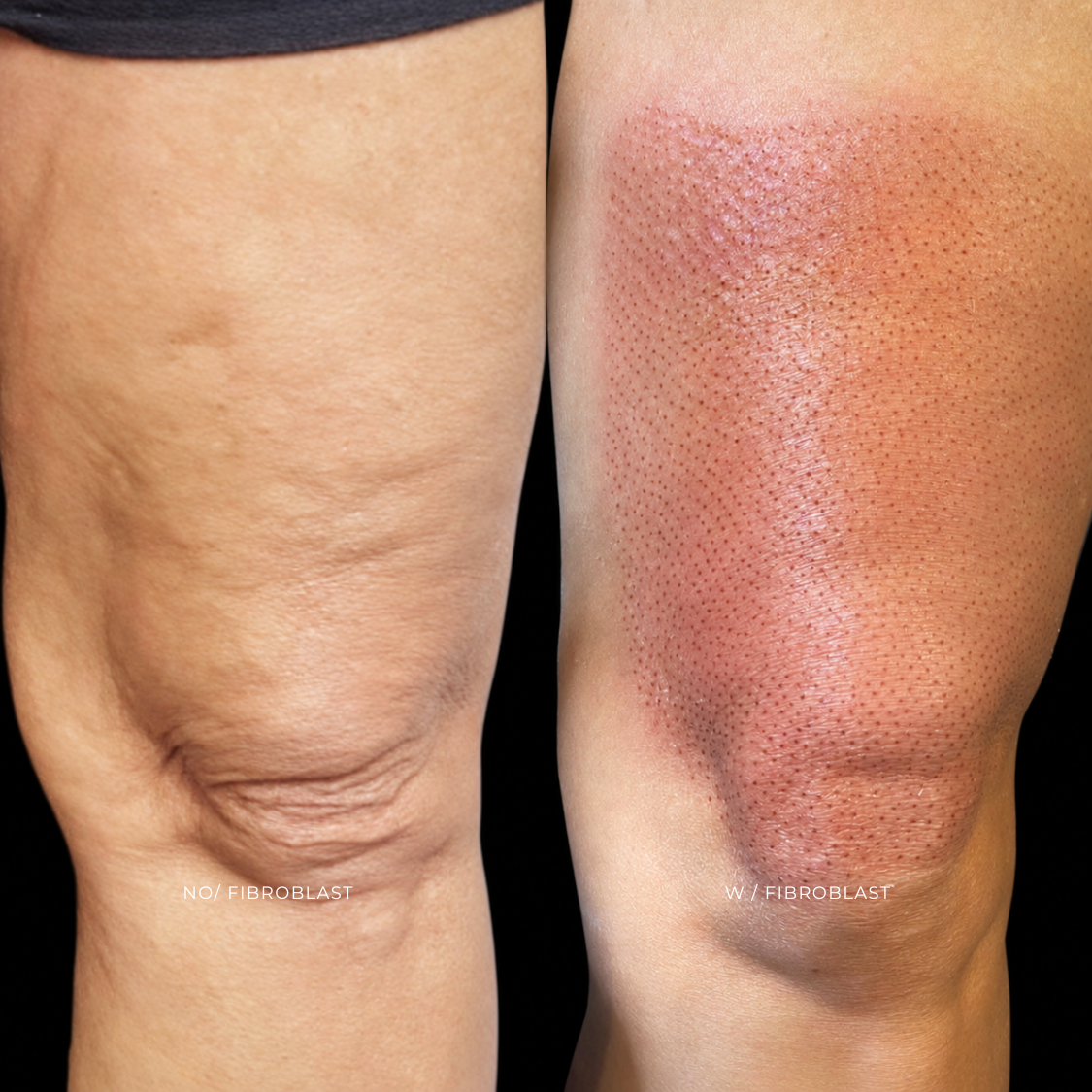 FIBROBLAST | RODILLAS at EROXSPA in Houston, TX