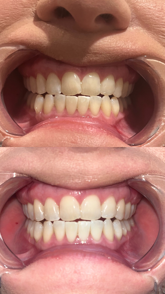 teeth whitening half hour