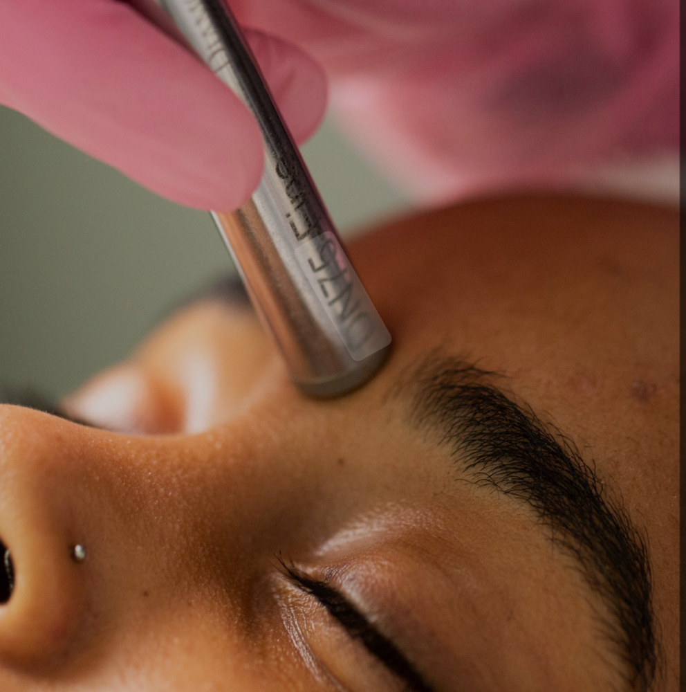 Microdermabrasion