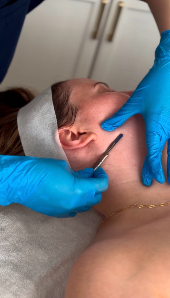 Dermaplane Treatment