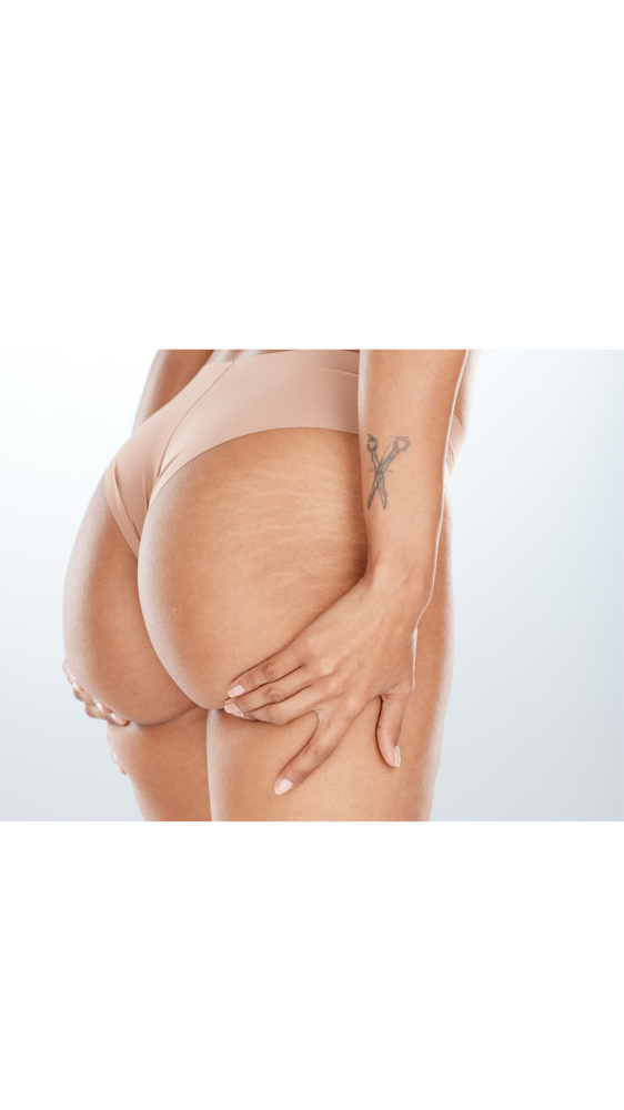 Non-Surgical butt Lift/ Hip Dips