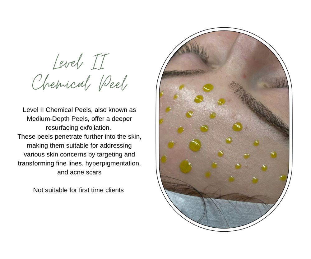 Level II Chemical Peel