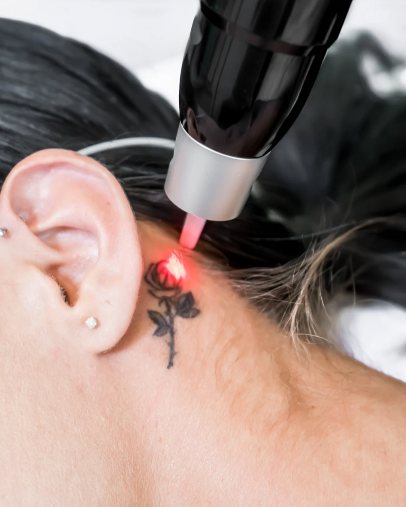 Laser Tattoo Removal