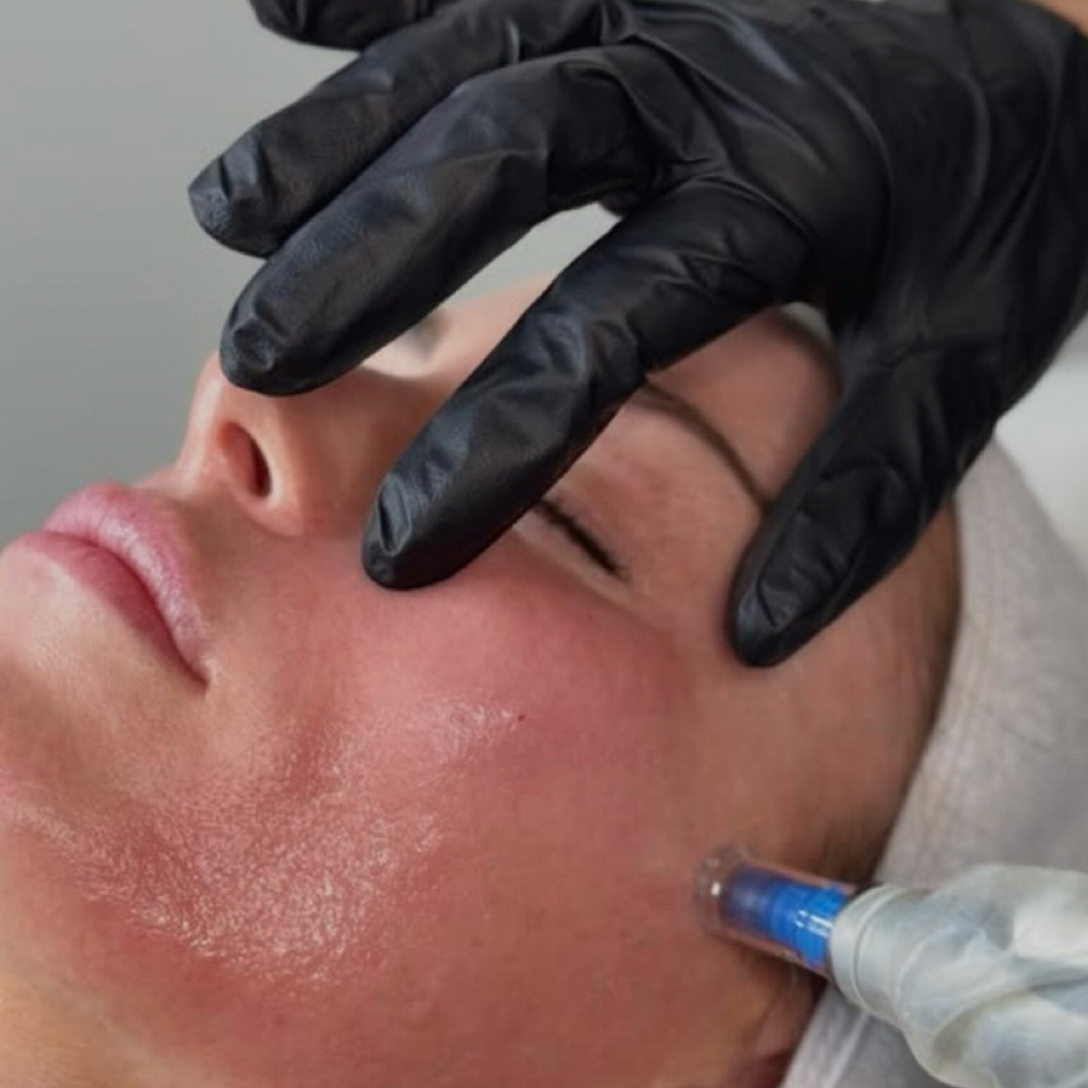 Microneedling Corrective Treatment at Esther Esthetics in Suwanee, GA