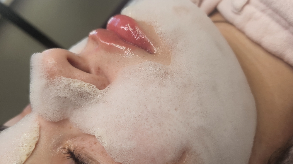 Acne Facial