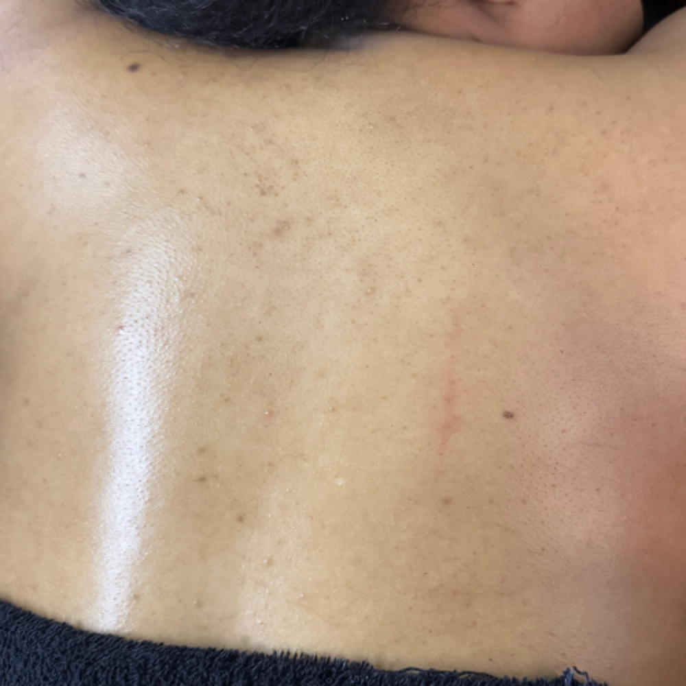 Back Treatment at The Beauty Canvas in Milwaukee, WI