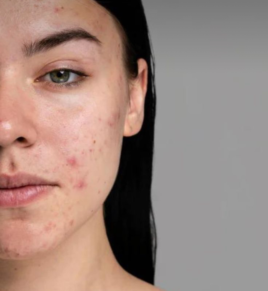 Acne Bootcamp (First Appointment)