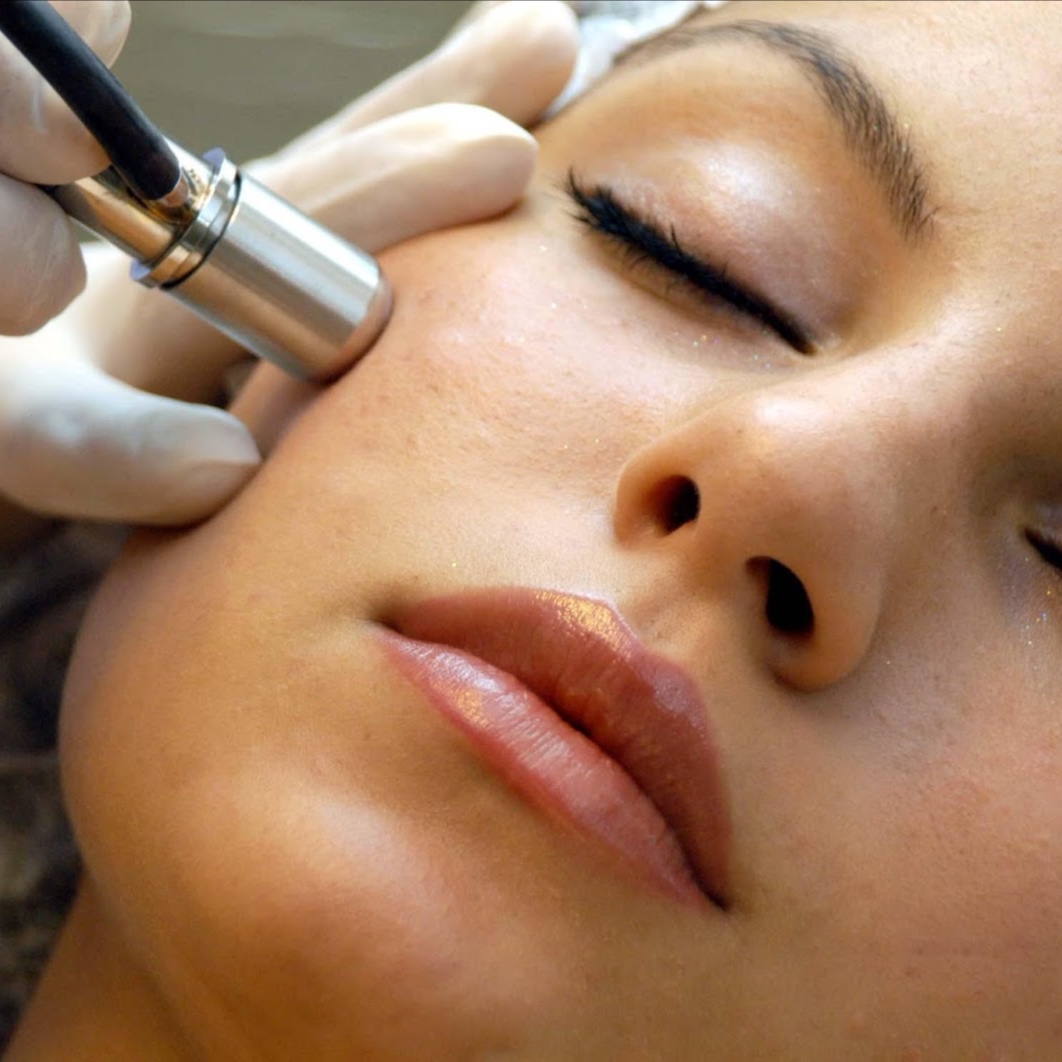 Microdermabrasion