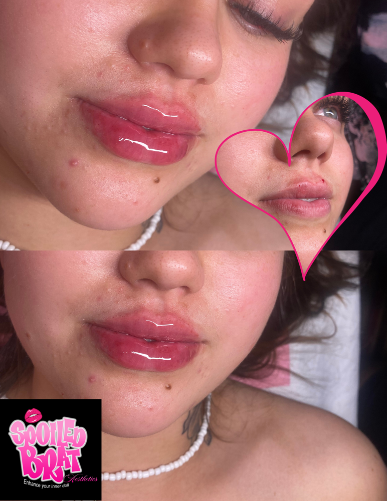 1ML MICRO NEEDLE LIP FILLER