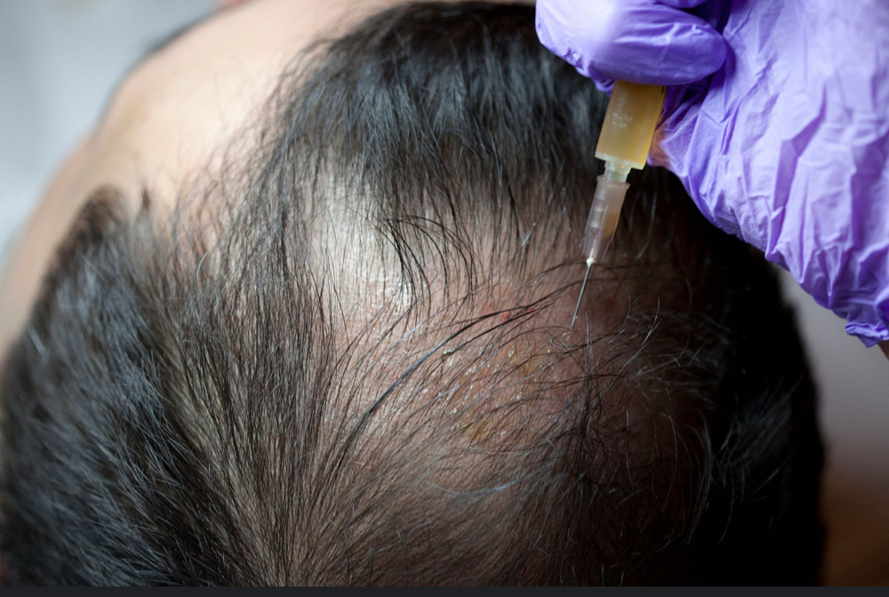 PRP Hair Restoration