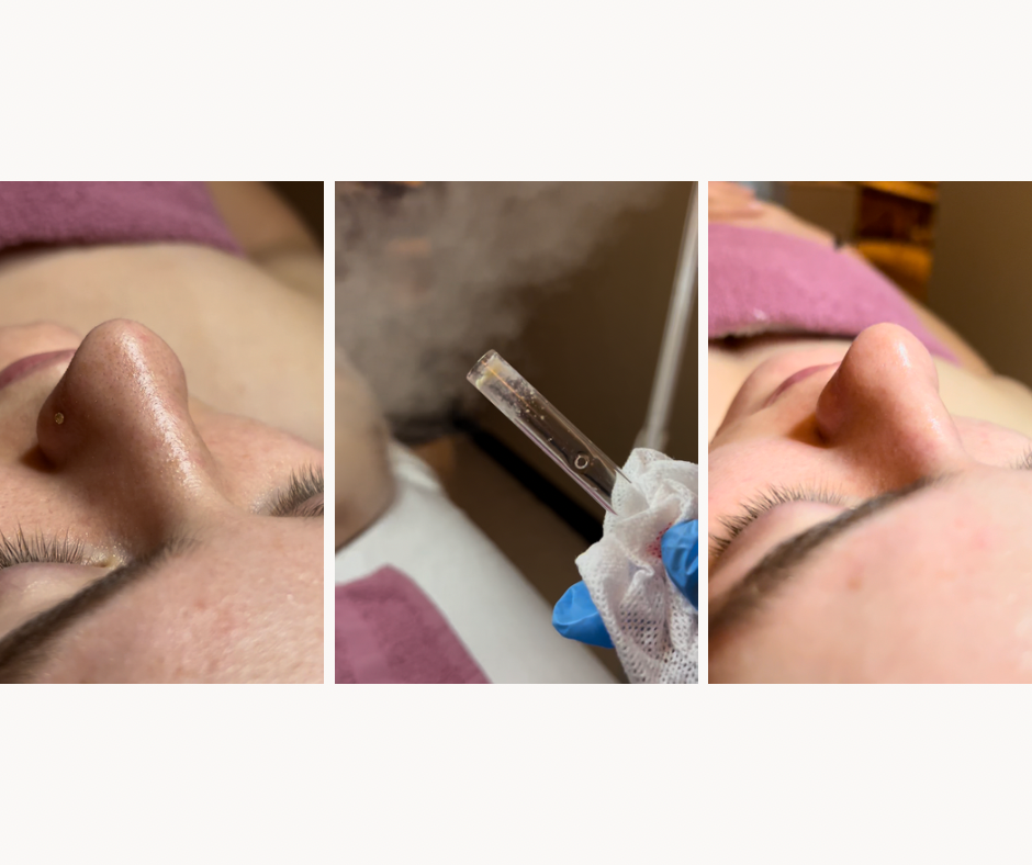 Ultimate Bare Facial