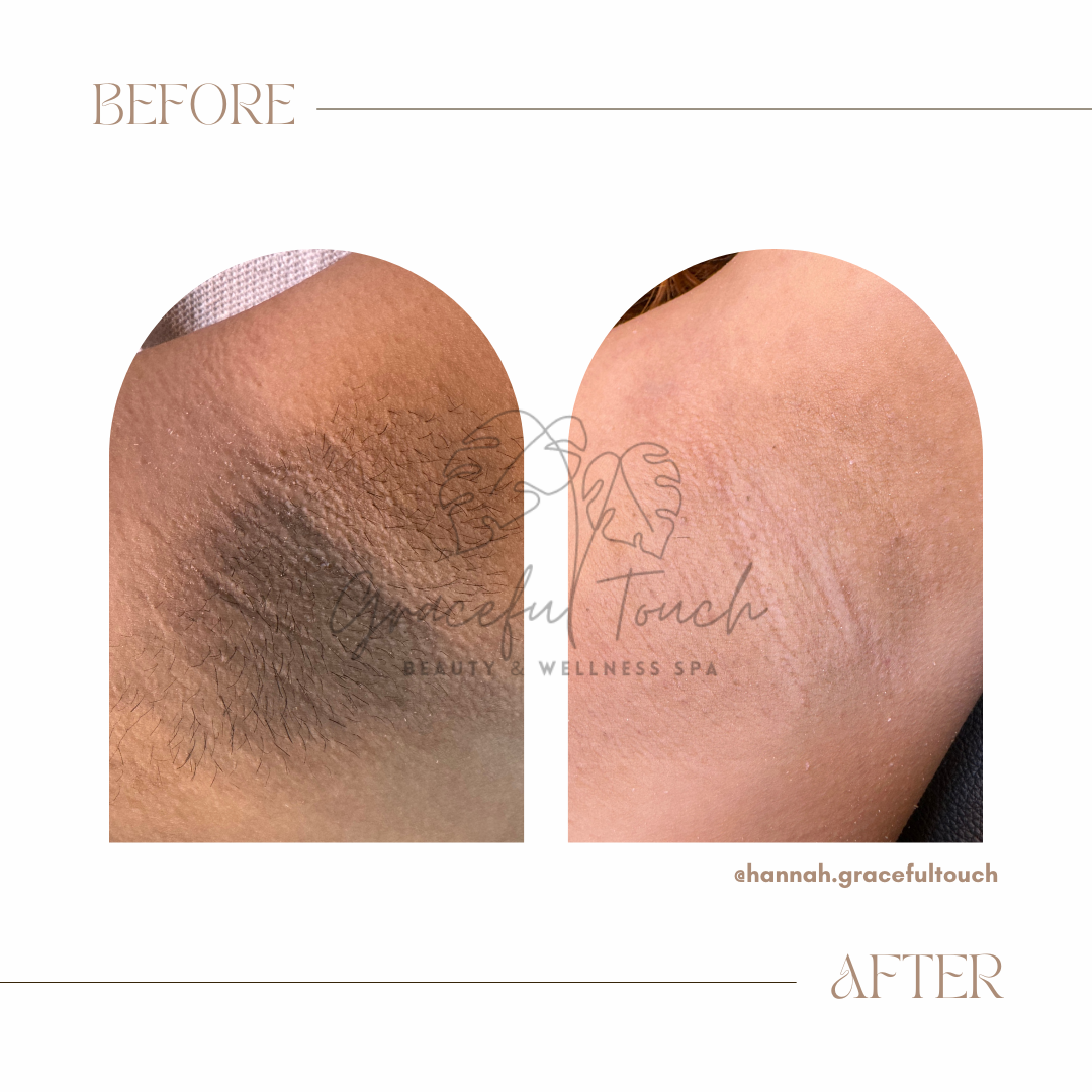 Unwanted hair