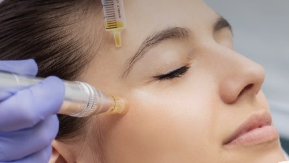 Microneedling w PRP