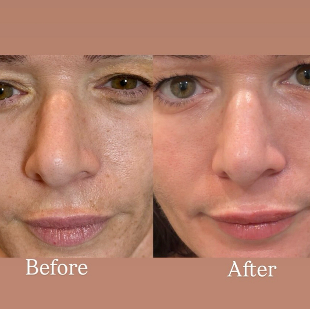 CO2 Resurfacing(NY) at Holistic Beauty in View On Website, NY